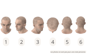 Positions de la tête pour un support capillaire en ligne SHIFT Greffe de Cheveux 1
