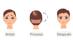 El proceso de trasplante capilar para mujeres en Estambul SHIFT Hair 3