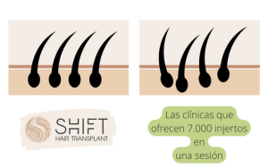 La diferencia entre la clínica capilar SHIFT y otras 3