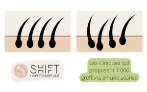 La différence entre la clinique capillaire SHIFT et les autres 3