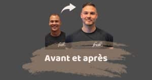 SHIFT Greffe de Cheveux Turquie Résultats 1