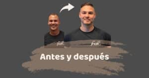 SHIFT Trasplante Capilar Turquía Resultados 1