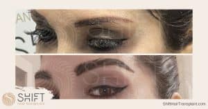 Trapianto di sopracciglia in Turchia Prima e Dopo con SHIFT Trapianto di Capelli a Istanbul 20 1
