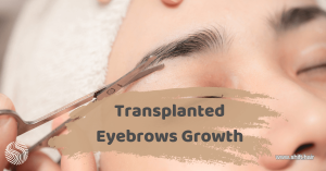 The featured image of the article Transplanted Eyebrow Growth by SHIFT Hair in Türkiye 3