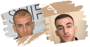Greffe de cheveux Image de la page d'accueil 3