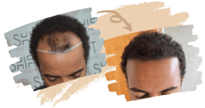 Trasplante de cabello afro Imagen de la página de inicio 3