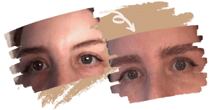 Trasplante de cejas Imagen de la página de inicio 3