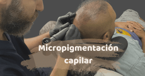 Micropigmentación capilar en Turquía 3