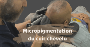 Micropigmentation du cuir chevelu en Turquie 3