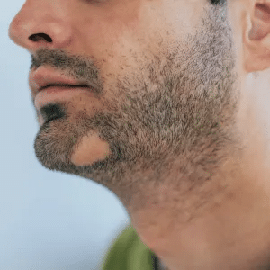 Il est efficace contre l'alopécie areata de la barbe.