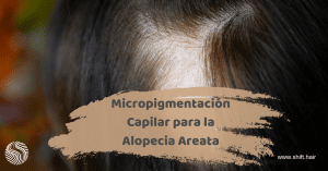 Micropigmentación Capilar para la Alopecia Areata 3