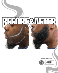 Afro Beard Transplant Turkey Before After SHIFT Hair Transplant in Istanbul 02 3