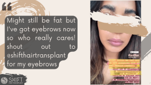 Afro Eyebrow Transplant Review with SHIFT Hair in Turkey 01 3