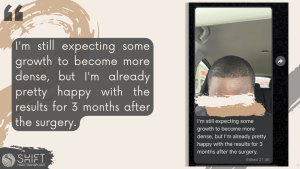 Afro Hair Transplant Review with SHIFT Hair in Turkey 04 3