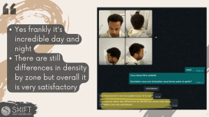 Afro Hair Transplant Review with SHIFT Hair in Turkey 07 3