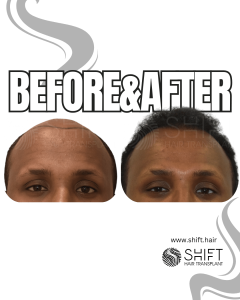 Afro Hair Transplant Turkey Before After SHIFT Hair Transplant in Istanbul 01 3