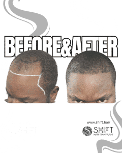 Afro Hair Transplant Turkey Before After SHIFT Hair Transplant in Istanbul 08 3