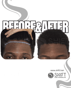 Afro Hair Transplant Turkey Before After SHIFT Hair Transplant in Istanbul 24 3