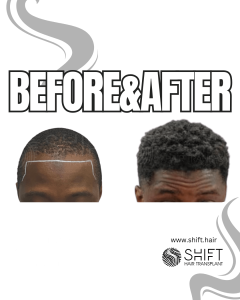 Afro Hair Transplant Turkey Before After SHIFT Hair Transplant in Istanbul 27 3