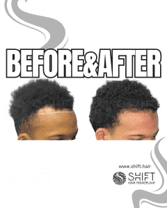 Afro Hair Transplant Turkey Before After SHIFT Hair Transplant in Istanbul 35 3
