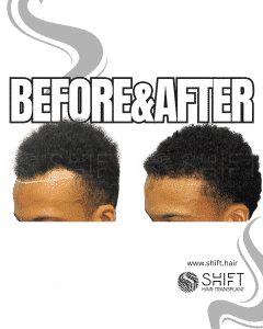 Afro Hair Transplant Turkey Before After SHIFT Hair Transplant in Istanbul 36 3