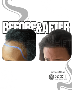Afro Hair Transplant for Women Turkey Before After SHIFT Hair Transplant in Istanbul 05 3