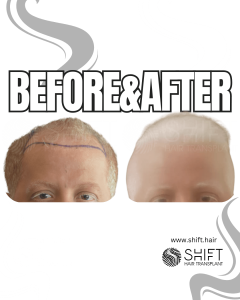 Albino Hair Transplant Turkey Before After SHIFT Hair Transplant in Istanbul 01 3