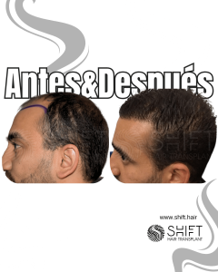 Antes Después Área donante Después del trasplante de cabello en Turquía en SHIFT Hair en Estambul 01 3