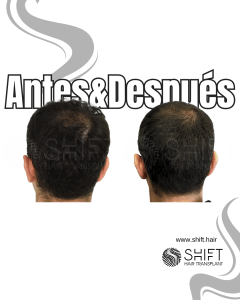 Antes Después Área donante Después del trasplante de cabello en Turquía en SHIFT Hair en Estambul 02 3
