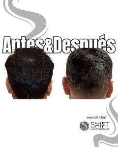 Antes Después Área donante Después del trasplante de cabello en Turquía en SHIFT Hair en Estambul 03 3