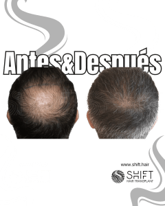 Antes Después de un trasplante capilar de corona en Turquía en SHIFT Hair en Estambul 01 3
