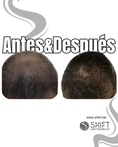 Antes Después de un trasplante capilar de corona en Turquía en SHIFT Hair en Estambul 03 3
