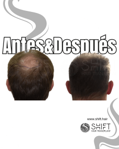 Antes Después de un trasplante capilar de corona en Turquía en SHIFT Hair en Estambul 05 3
