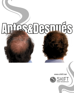Antes Después de un trasplante capilar de corona en Turquía en SHIFT Hair en Estambul 06 3