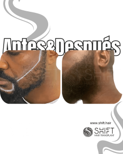 Antes Después de un trasplante de barba afro en Turquía en SHIFT Hair en Estambul 01 3