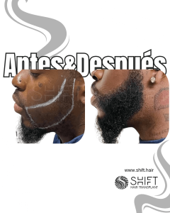 Antes Después de un trasplante de barba afro en Turquía en SHIFT Hair en Estambul 02 3