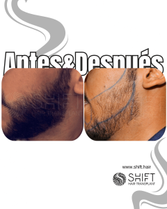 Antes Después de un trasplante de barba en Turquía en SHIFT Hair en Estambul 04 3
