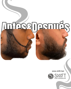 Antes Después de un trasplante de barba en Turquía en SHIFT Hair en Estambul 06 3