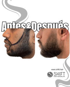 Antes Después de un trasplante de barba en Turquía en SHIFT Hair en Estambul 07 3