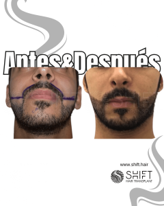 Antes Después de un trasplante de barba en Turquía en SHIFT Hair en Estambul 08 3