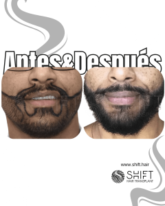 Antes Después de un trasplante de barba en Turquía en SHIFT Hair en Estambul 17 3