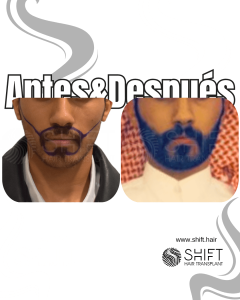 Antes Después de un trasplante de barba en Turquía en SHIFT Hair en Estambul 21 3