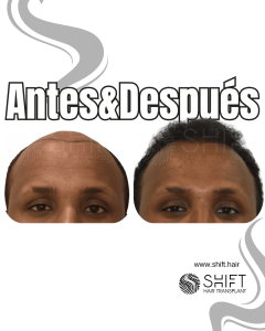 Antes Después de un trasplante de cabello afro en Turquía en SHIFT Hair en Estambul 01 3