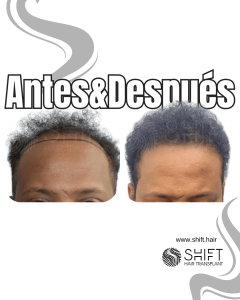 Antes Después de un trasplante de cabello afro en Turquía en SHIFT Hair en Estambul 03 3