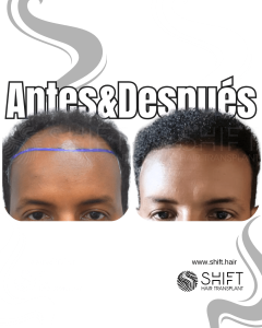 Antes Después de un trasplante de cabello afro en Turquía en SHIFT Hair en Estambul 04 3