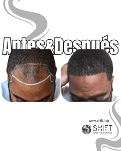 Antes Después de un trasplante de cabello afro en Turquía en SHIFT Hair en Estambul 05 3