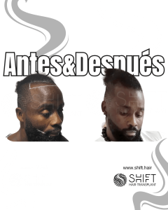 Antes Después de un trasplante de cabello afro en Turquía en SHIFT Hair en Estambul 06 3