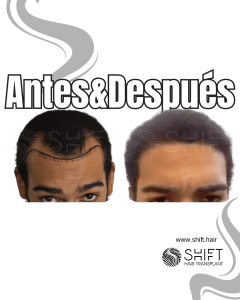 Antes Después de un trasplante de cabello afro en Turquía en SHIFT Hair en Estambul 07 3