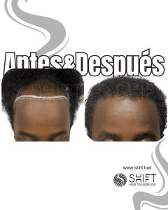 Antes Después de un trasplante de cabello afro en Turquía en SHIFT Hair en Estambul 10 3