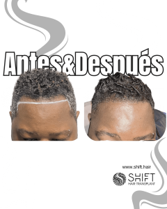 Antes Después de un trasplante de cabello afro en Turquía en SHIFT Hair en Estambul 11 3